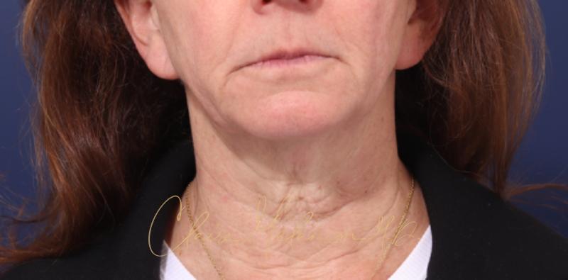 Chin Implant Before & After Photo