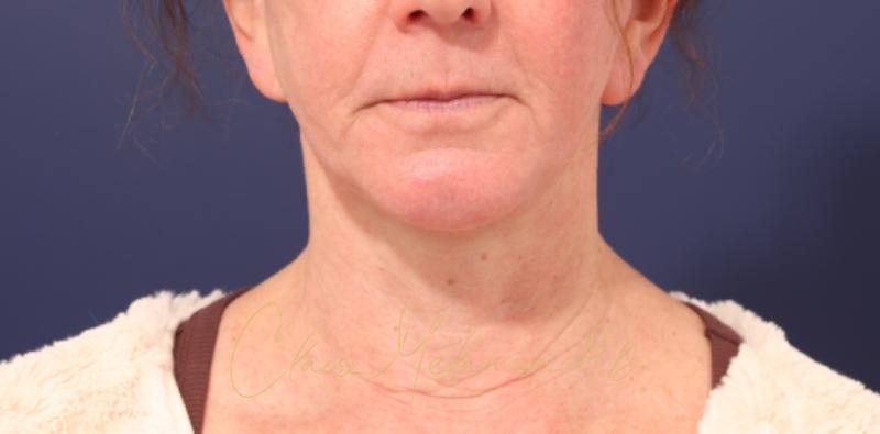 Chin Implant Before & After Photo