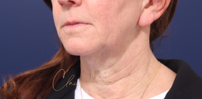 Chin Implant Before & After Photo
