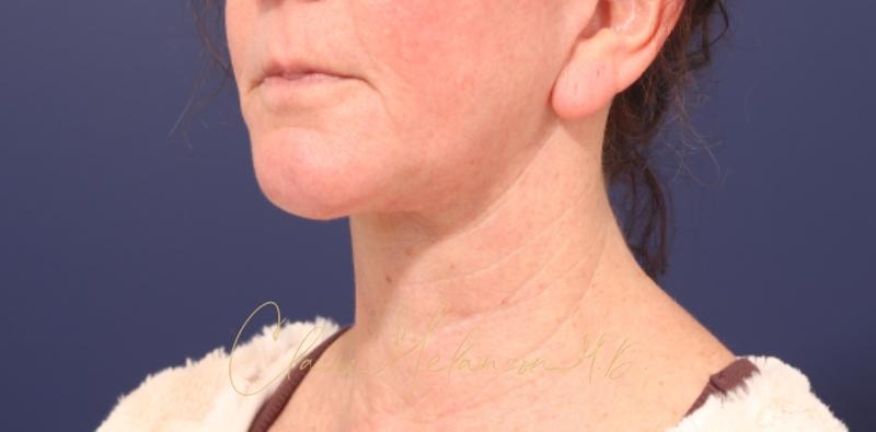 Chin Implant Before & After Photo