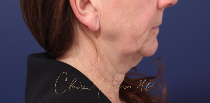Chin Implant Before & After Photo