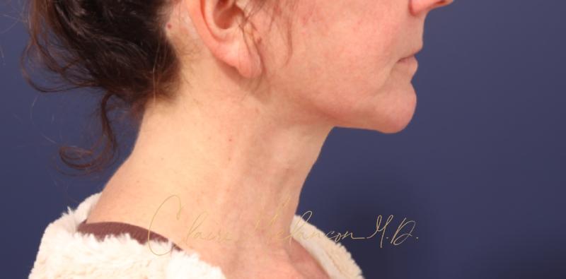 Chin Implant Before & After Photo