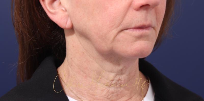Chin Implant Before & After Photo