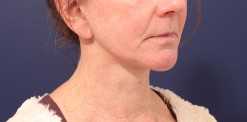 Chin Implant Before & After Photo