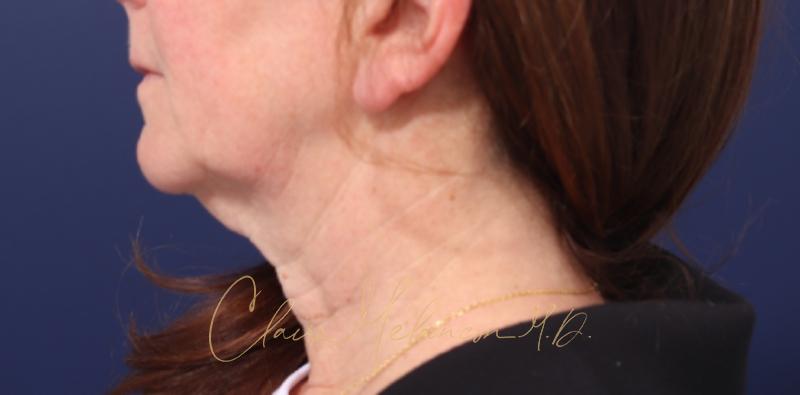 Chin Implant Before & After Photo