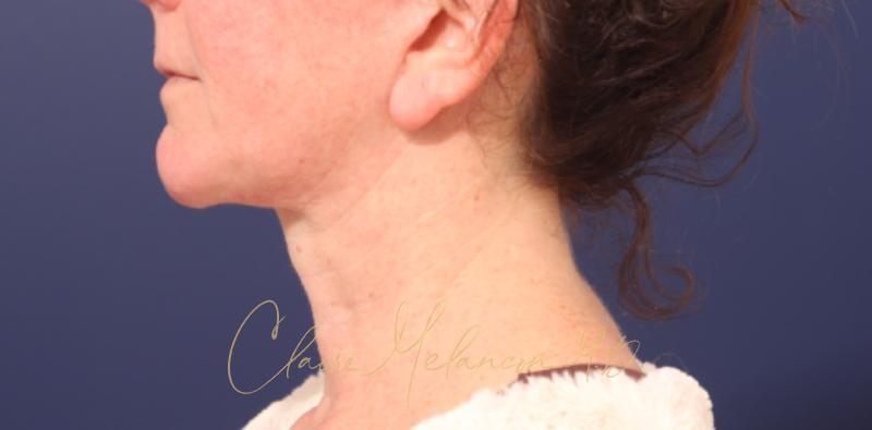 Chin Implant Before & After Photo
