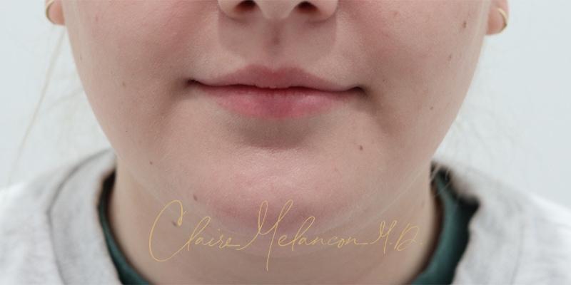 Deep Neck Lift Before & After Photo