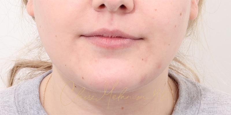 Deep Neck Lift Before & After Photo