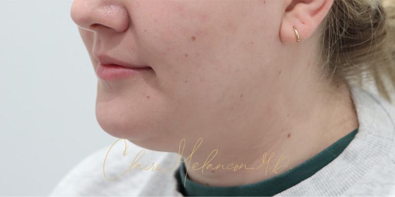 Deep Neck Lift Before & After Photo