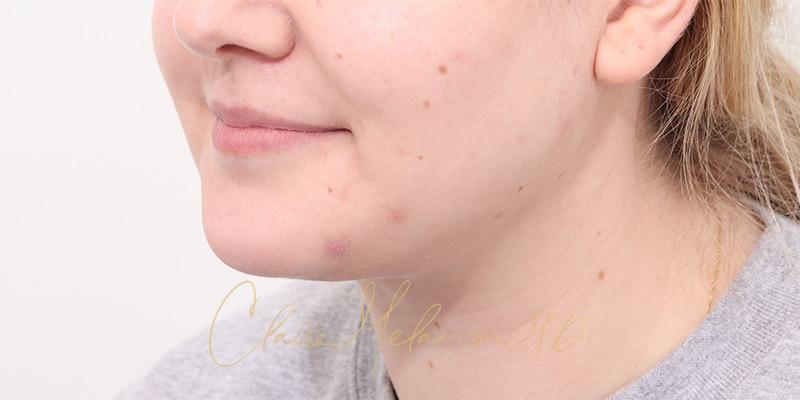 Deep Neck Lift Before & After Photo