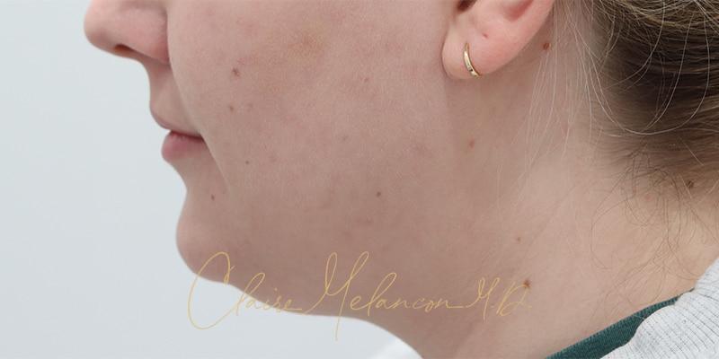 Deep Neck Lift Before & After Photo