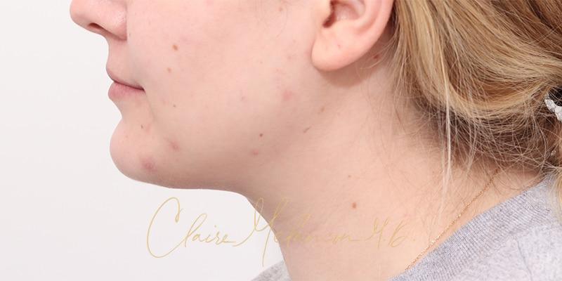 Deep Neck Lift Before & After Photo