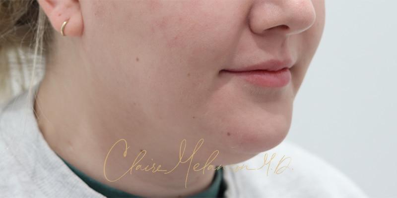 Deep Neck Lift Before & After Photo