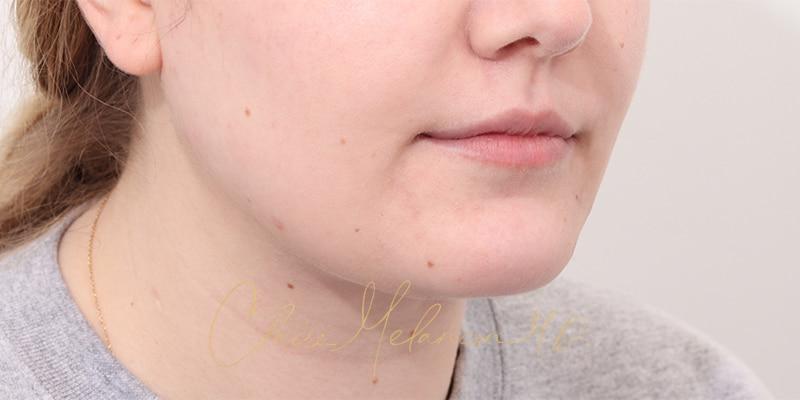 Deep Neck Lift Before & After Photo