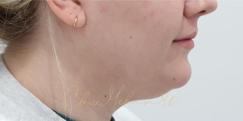 Deep Neck Lift Before & After Photo