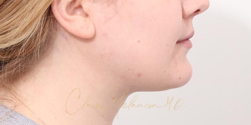 Deep Neck Lift Before & After Photo