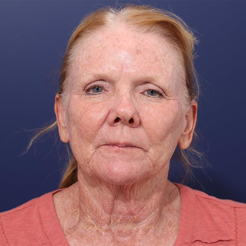 Facelift Before & After Photo