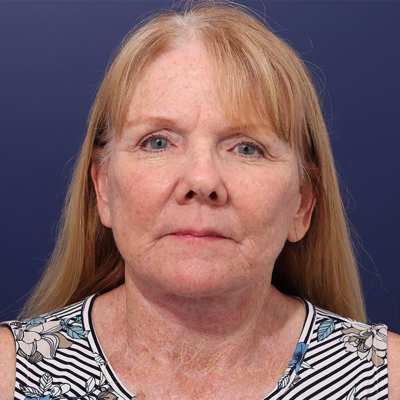 Facelift Before & After Photo