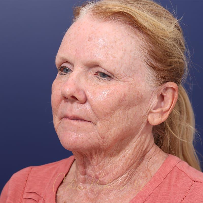 Facelift Before & After Photo