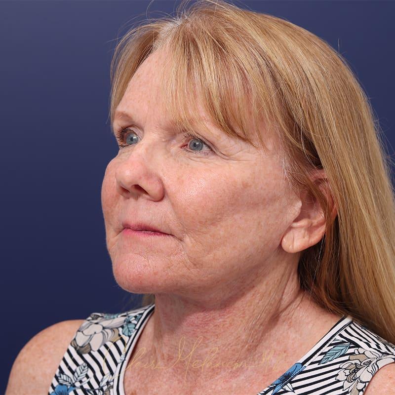 Facelift Before & After Photo