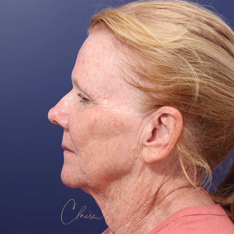 Facelift Before & After Photo