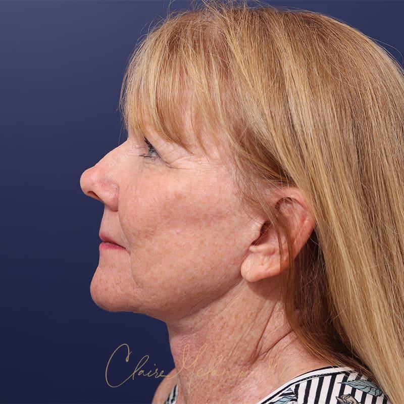 Facelift Before & After Photo