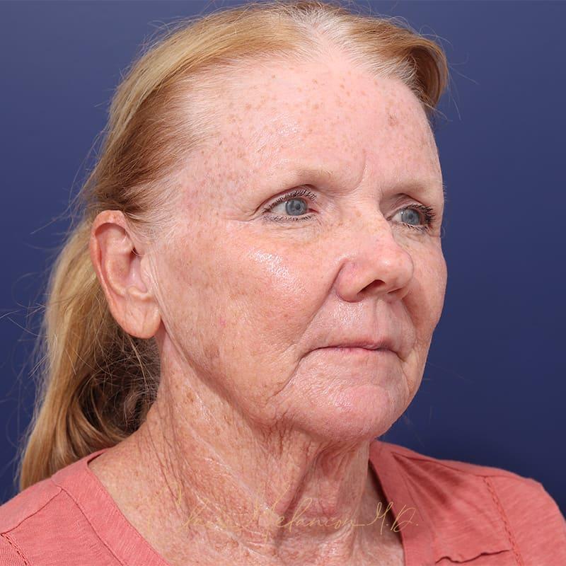 Facelift Before & After Photo