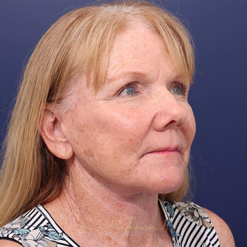 Facelift Before & After Photo