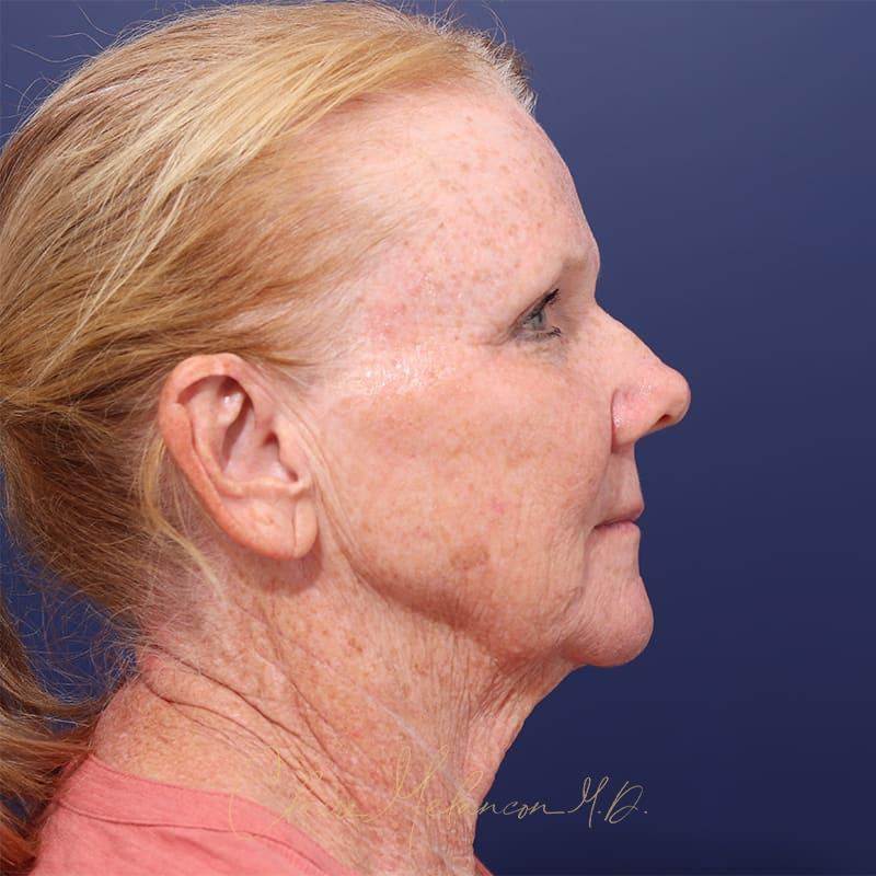 Facelift Before & After Photo