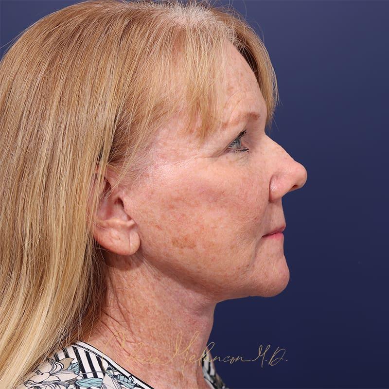 Facelift Before & After Photo