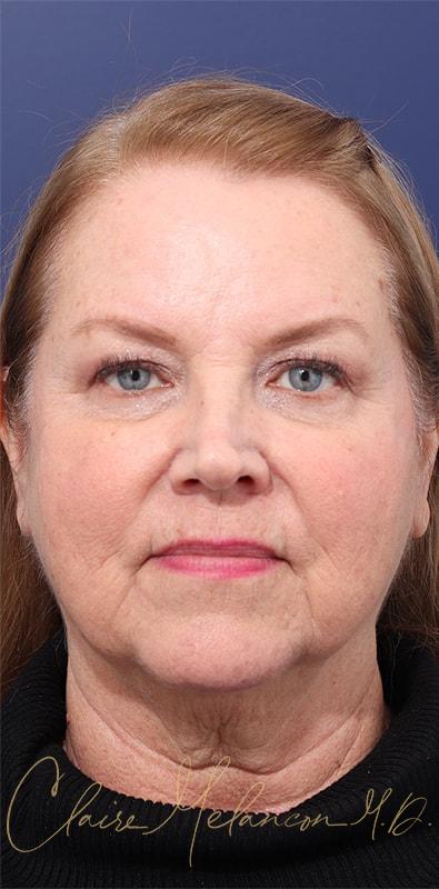 Facelift Before & After Photo