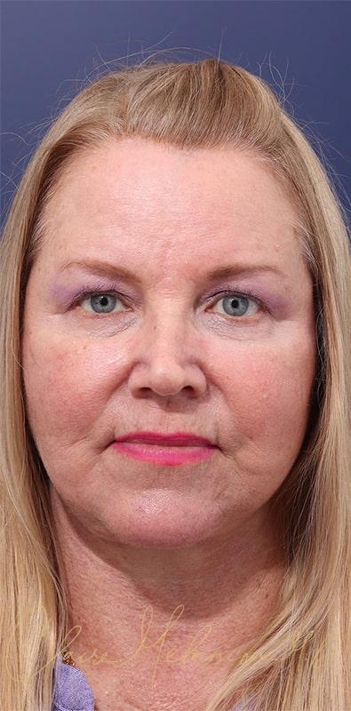 Facelift Before & After Photo