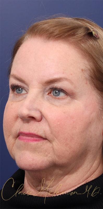 Facelift Before & After Photo