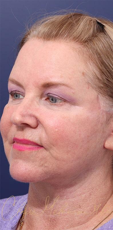 Facelift Before & After Photo