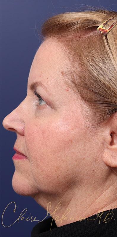 Facelift Before & After Photo