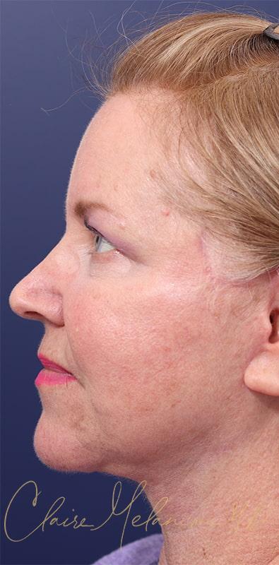 Facelift Before & After Photo