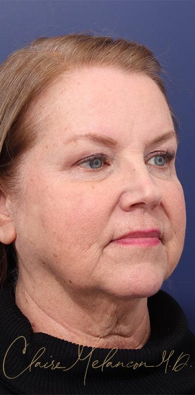 Facelift Before & After Photo