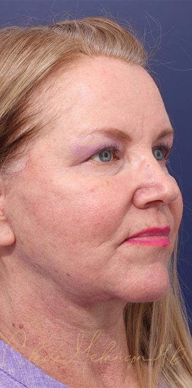 Facelift Before & After Photo
