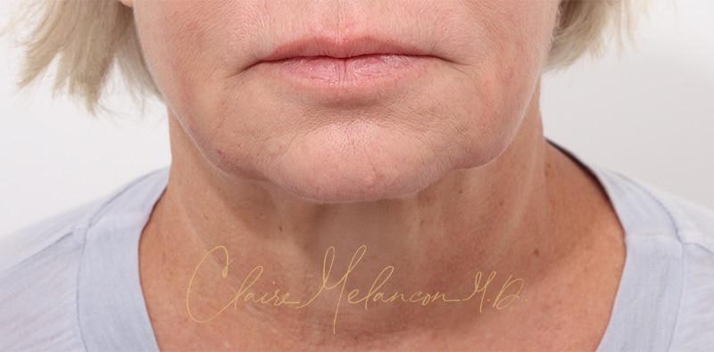 Facelift Before & After Photo