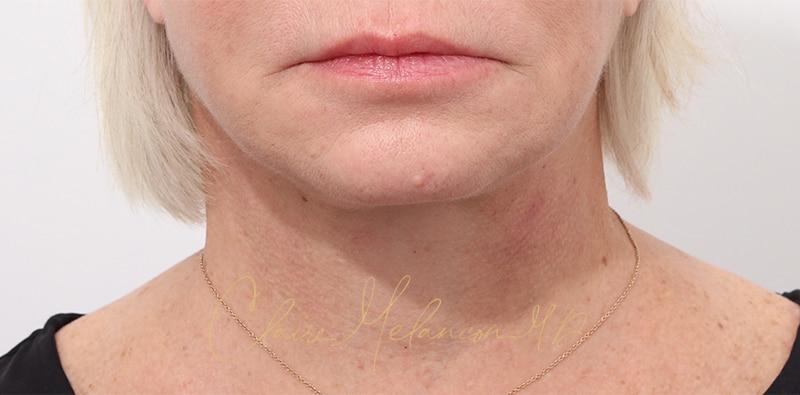 Facelift Before & After Photo