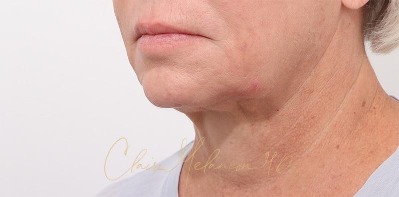 Facelift Before & After Photo