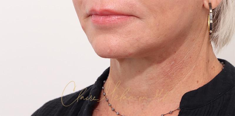 Facelift Before & After Photo
