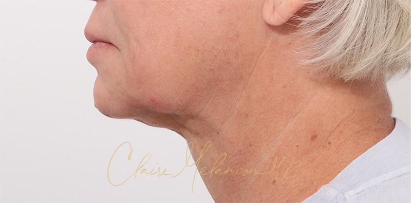 Facelift Before & After Photo