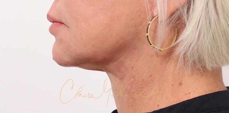 Facelift Before & After Photo