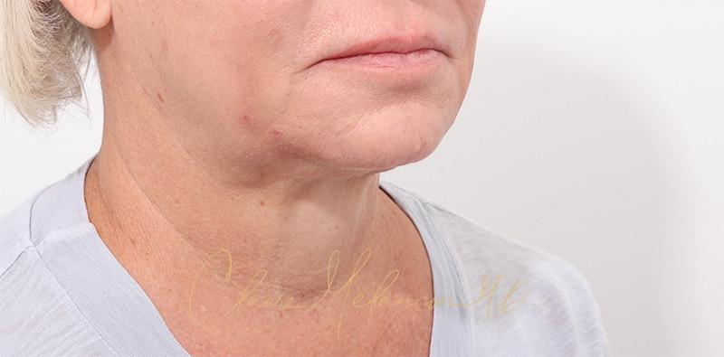 Facelift Before & After Photo