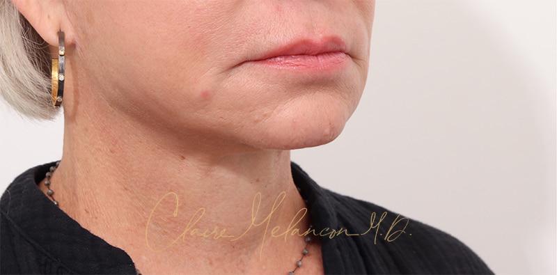 Facelift Before & After Photo