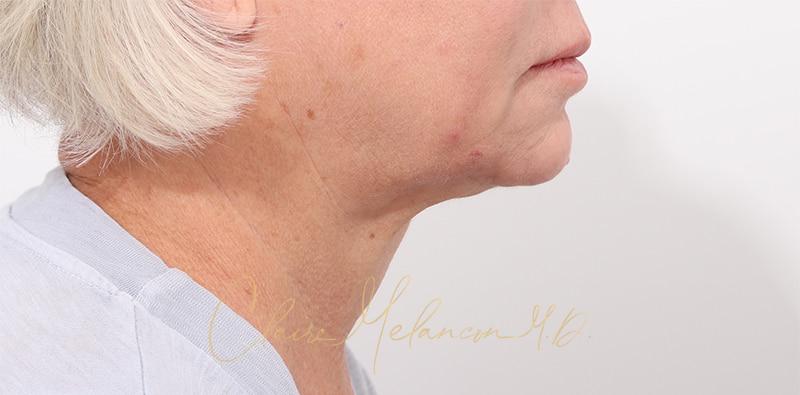 Facelift Before & After Photo
