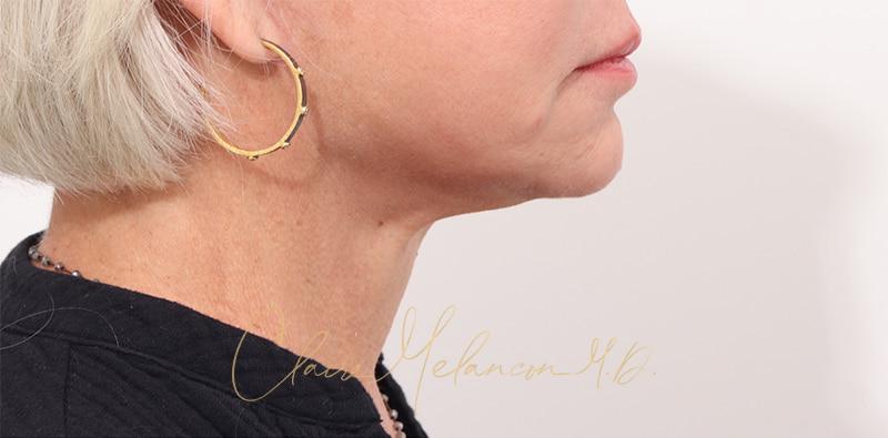 Facelift Before & After Photo