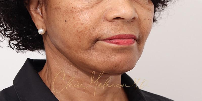 Facelift Before & After Photo