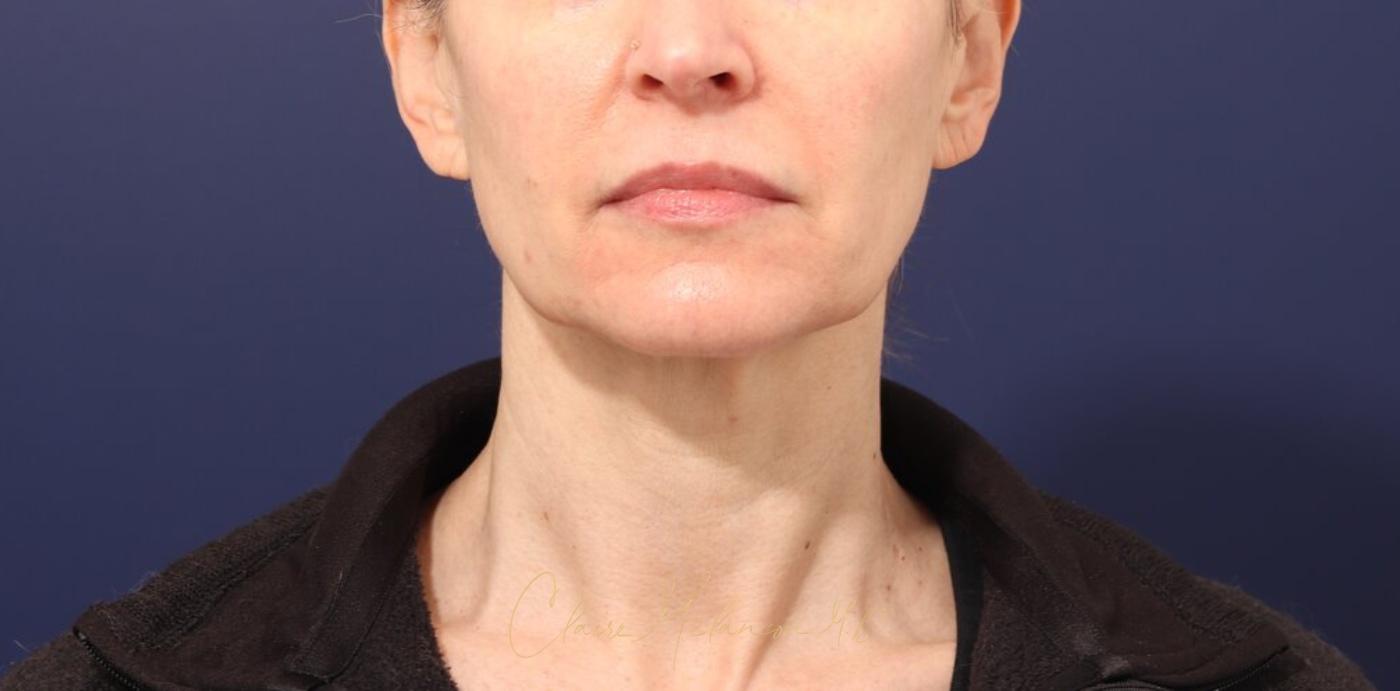 Facelift Before & After Photo